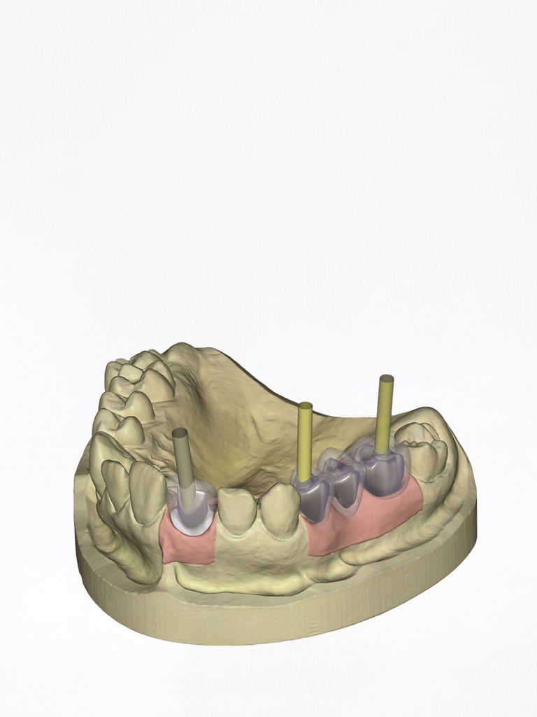 DentalCAD - Modulo Impianti