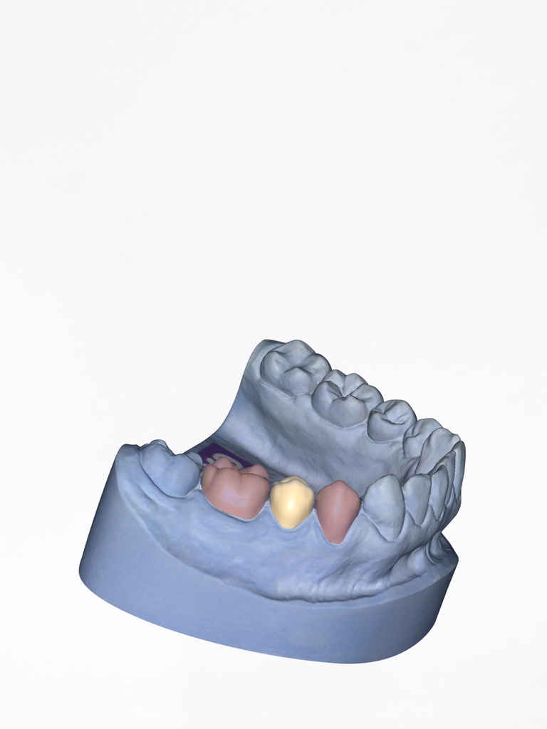 DentalCAD - Modulo Provvisori Flex