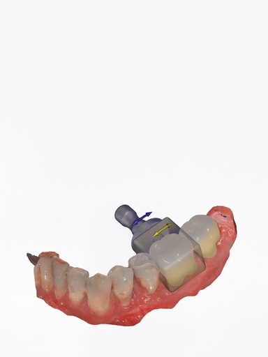 DentalCAD - Modulo In-CAD Nesting